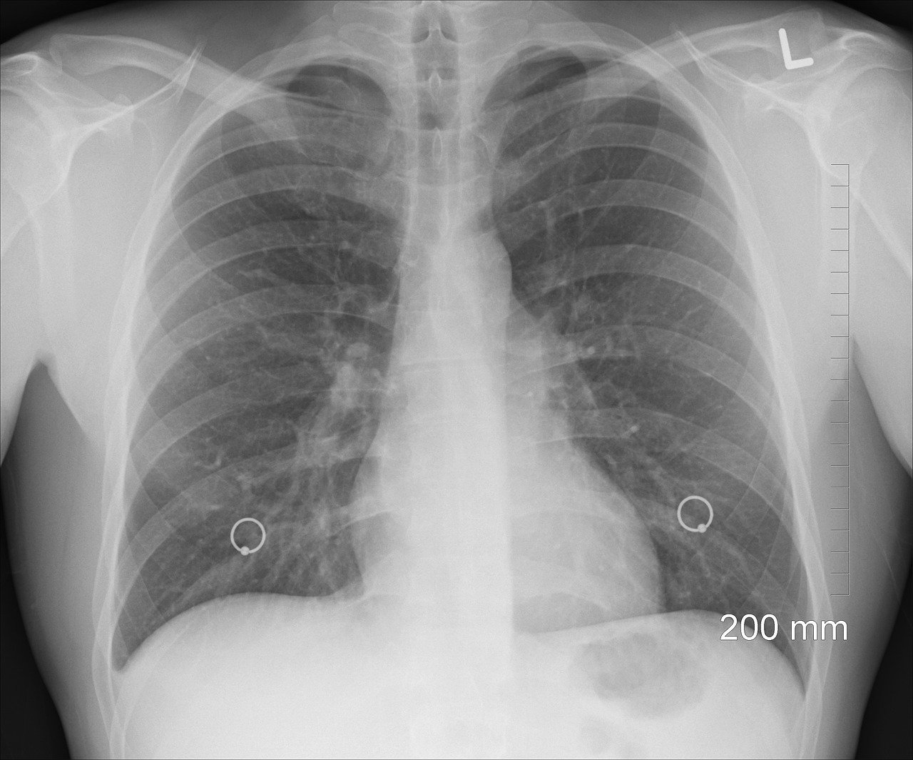 Mustavalkoinen röntgenkuva ihmisen rintakehän alueesta.