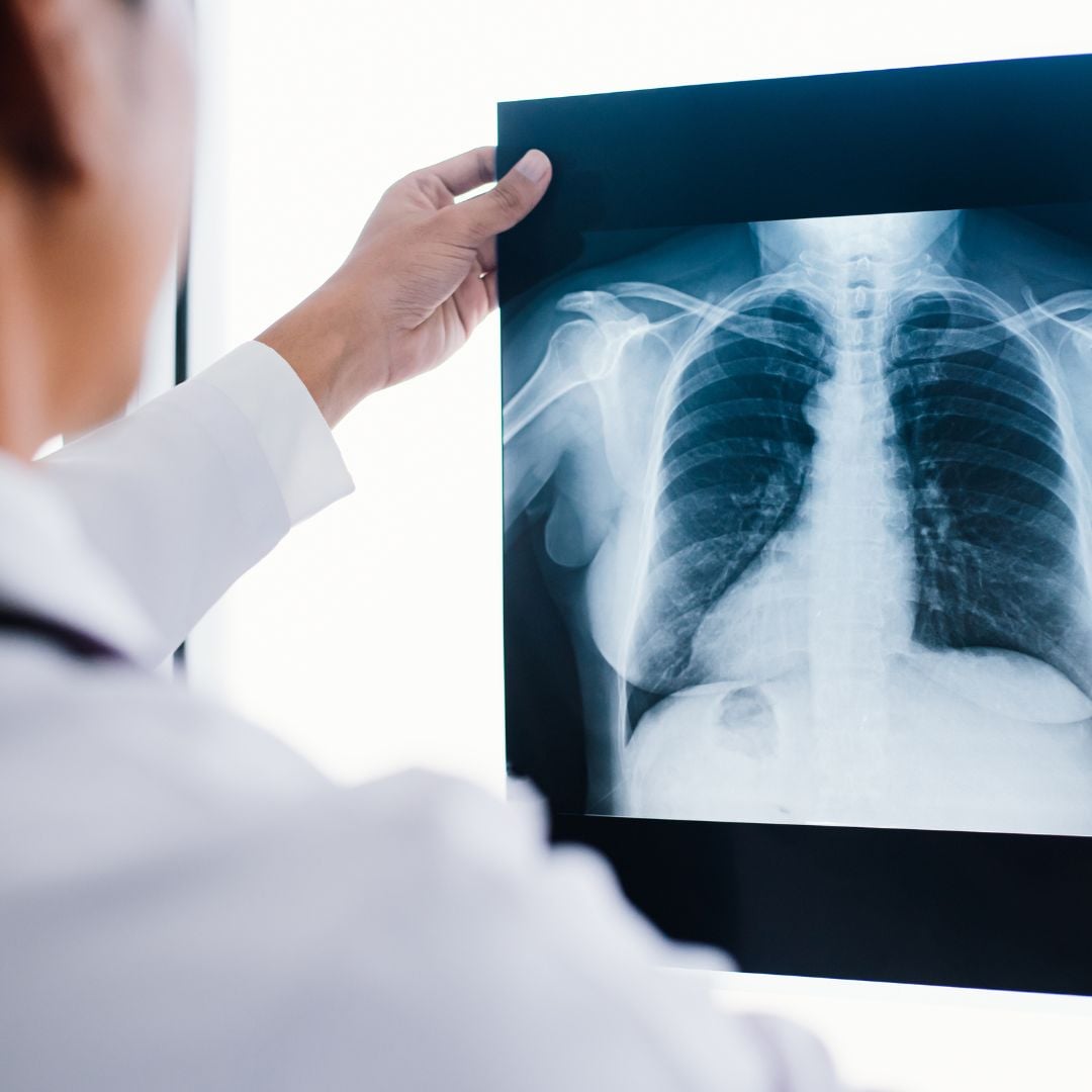 valkotakkinen lääkäri pitelee kädessään röntgenkuvaa. Kuvassa ihmisen ylävartalon röntgenkuva.